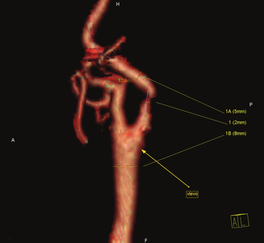 Symptomatická stenóza krkavice dle CT-angiografie.