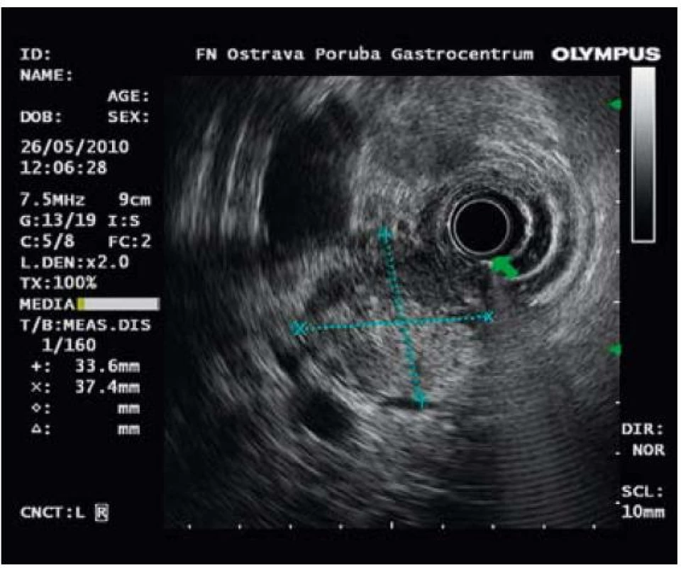 Endosonografický obraz hlavy pankratu. Ložiskové zvětšení rozměrů 33,6 × 37,4 mm. Echogenita je smíšená.
Fig. 2. Endosonographic imaging of the pancreatic head with focal enlargement of 33.6 × 37.4 mm and mixed echogenicity.