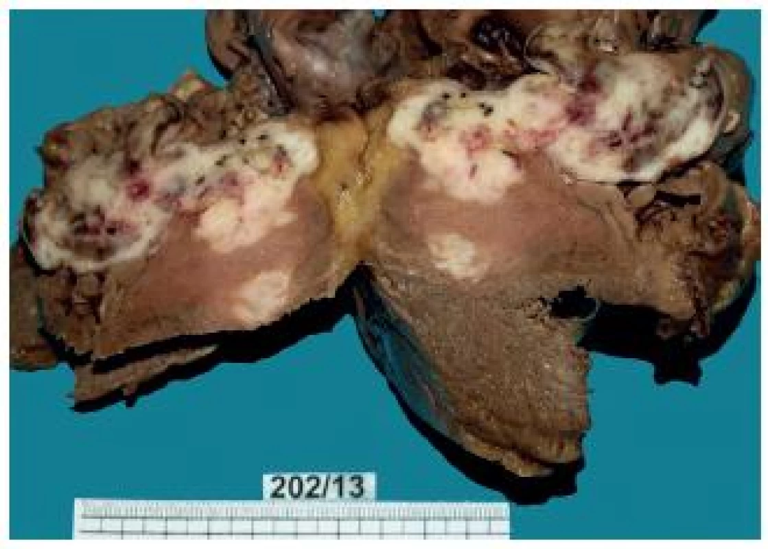 Heart – a metastasis mostly infiltrating the right ventricular myocardium and ventricular septum.