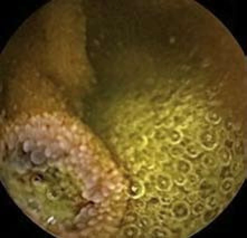 Polyp jejuna, kapslová enteroskopie.
Fig. 2. Polyp in jejunum, capsulle enteroscopy.