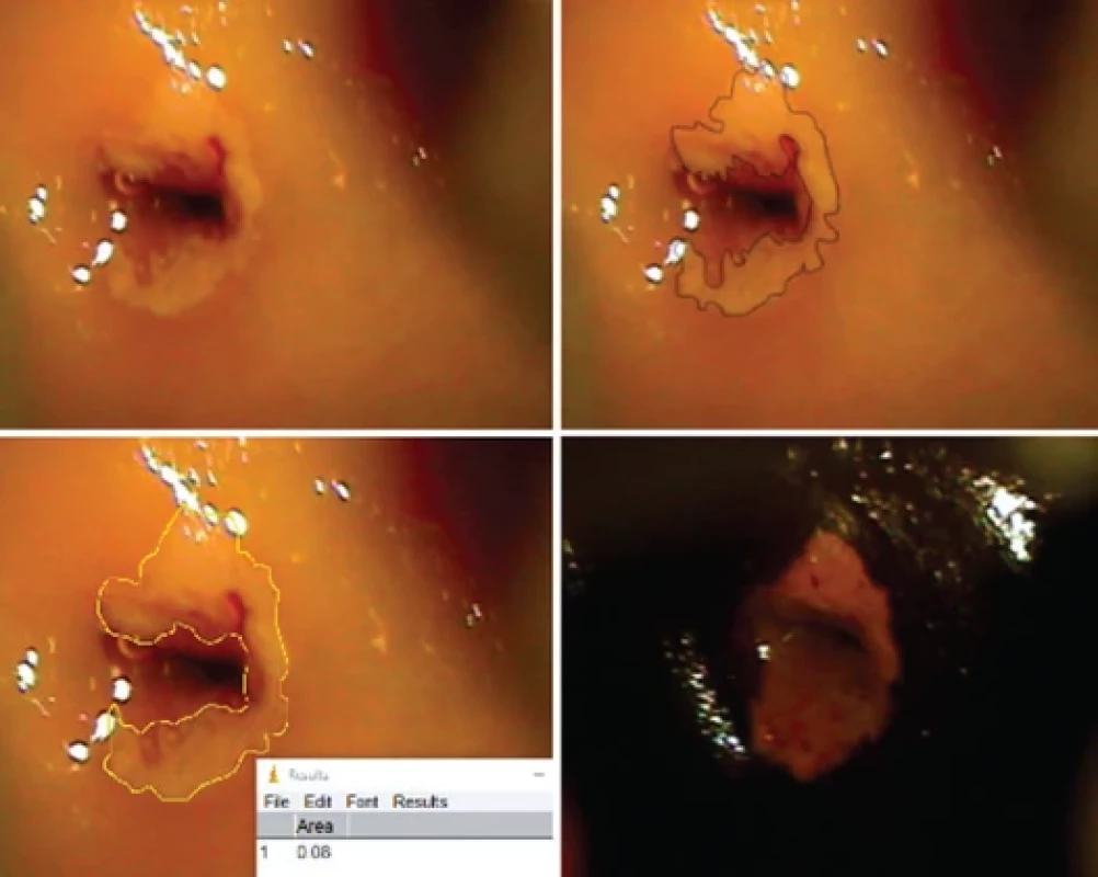 Colposcopic image of the lesion at 16× magnifi cation and analysis of the area of the lesion using Image J software. The pathological analysis showed CIN 3.