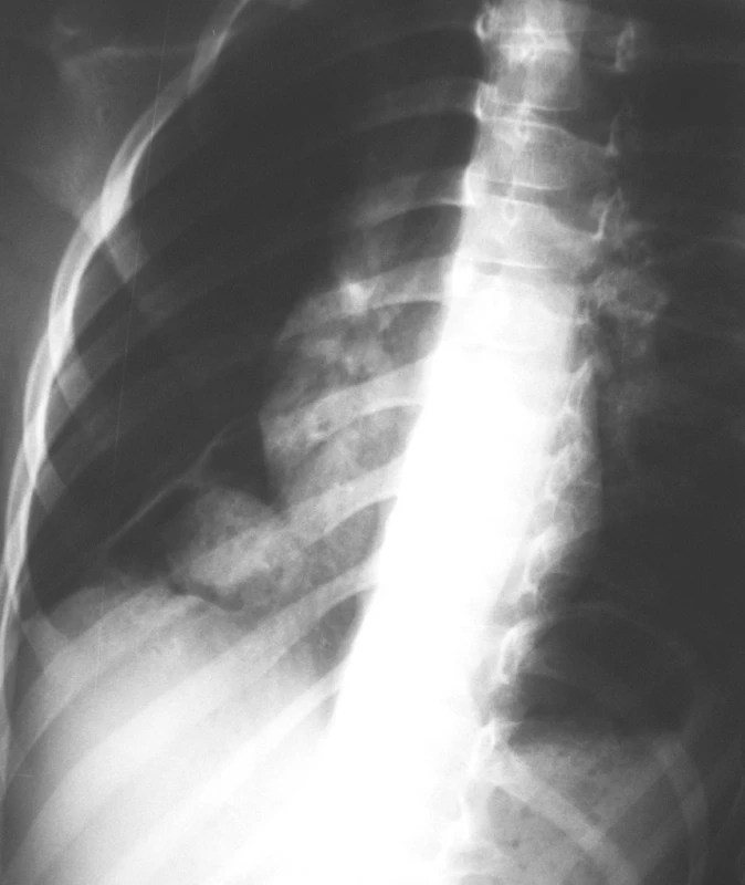 RTG snímka hrudníka, kde suponované na Tu expanziu vpravo bazálne
Fig. 5. Chest x-ray, a supposed tumor expansion in the right base.