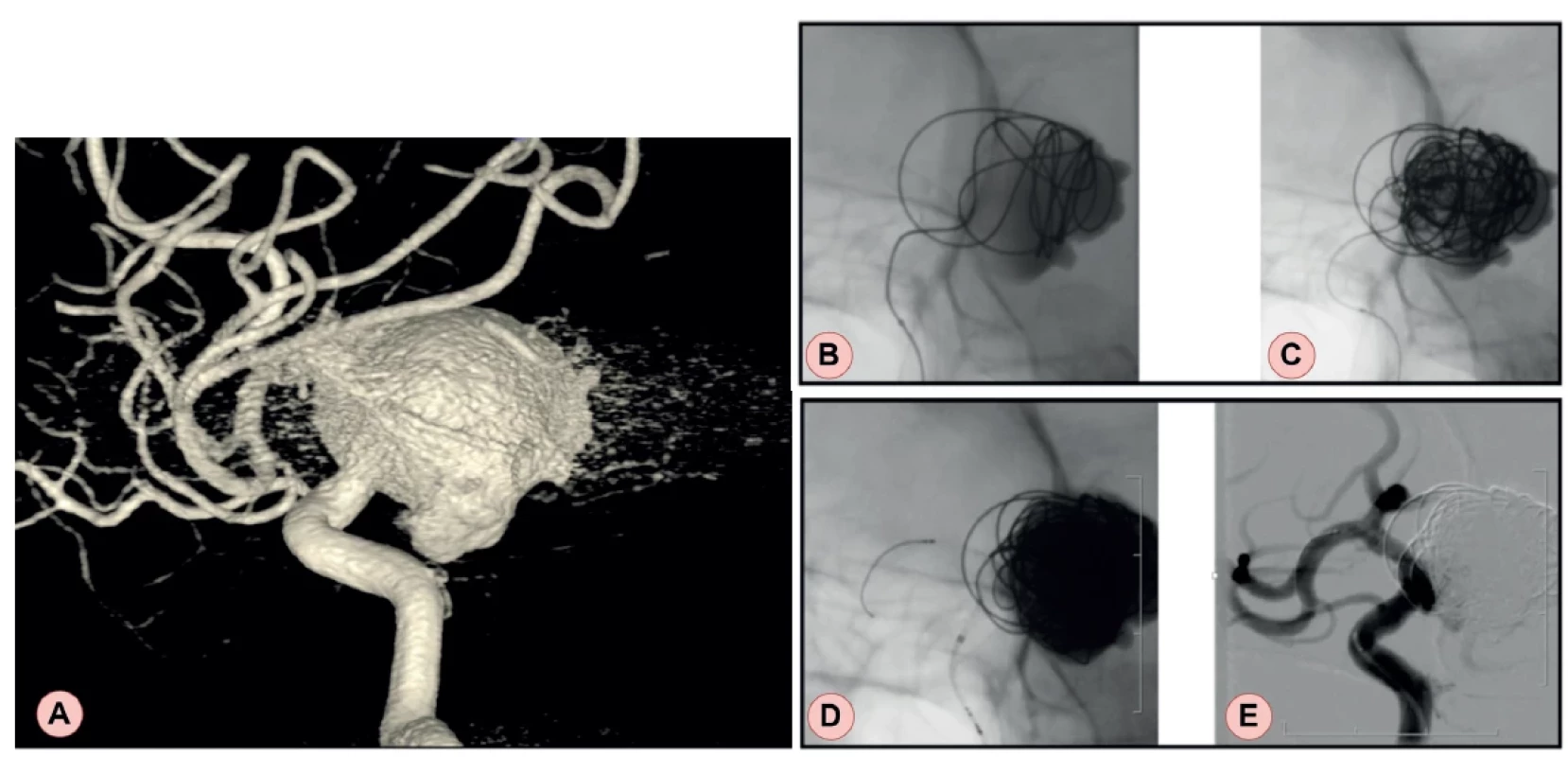 Intracranial aneurysm in a patient from the second case report