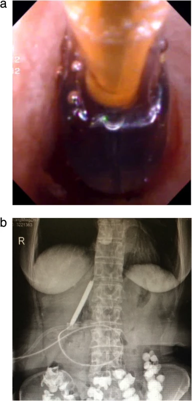 Balloon dilation of anastomotic strictures: a) Choledochoscopic balloon dilatation of the anastomotic stricture under the guidance of the yellow zebra guide wire. b) Balloon dilation under X-ray