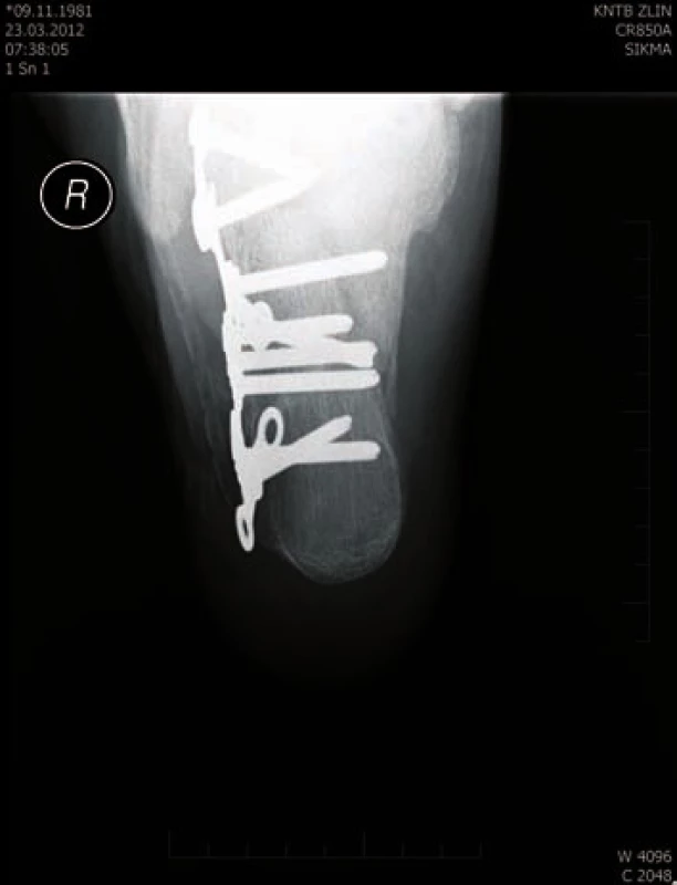 Osteosyntéza LCP Synthes - axiální projekce