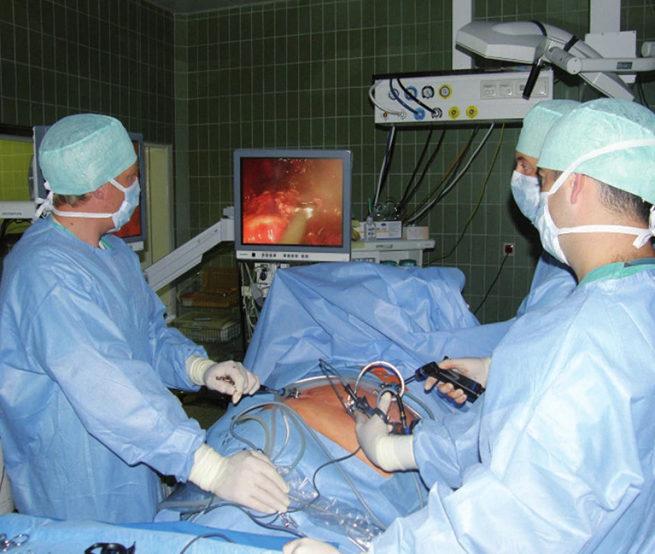 Laparoskopická pravostranná adrenalektomie
Fig. 2. Laparoscopic adrenalectomy on right side