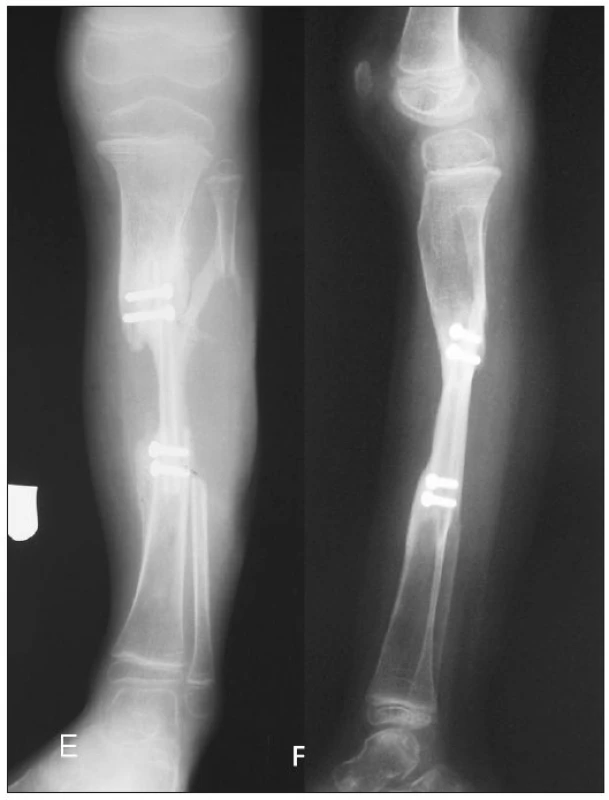 a. Two years follow-up – PA view
b. Two years follow-up – lateral view