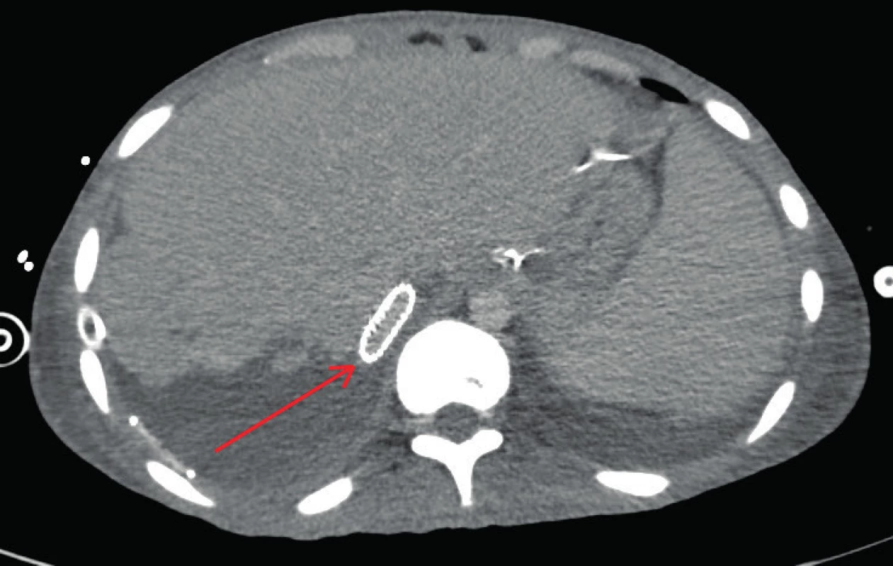 Komprese stentu VCI levým jaterním lalokem
Fig. 4. IVC stent compression by the left hepatic lobe