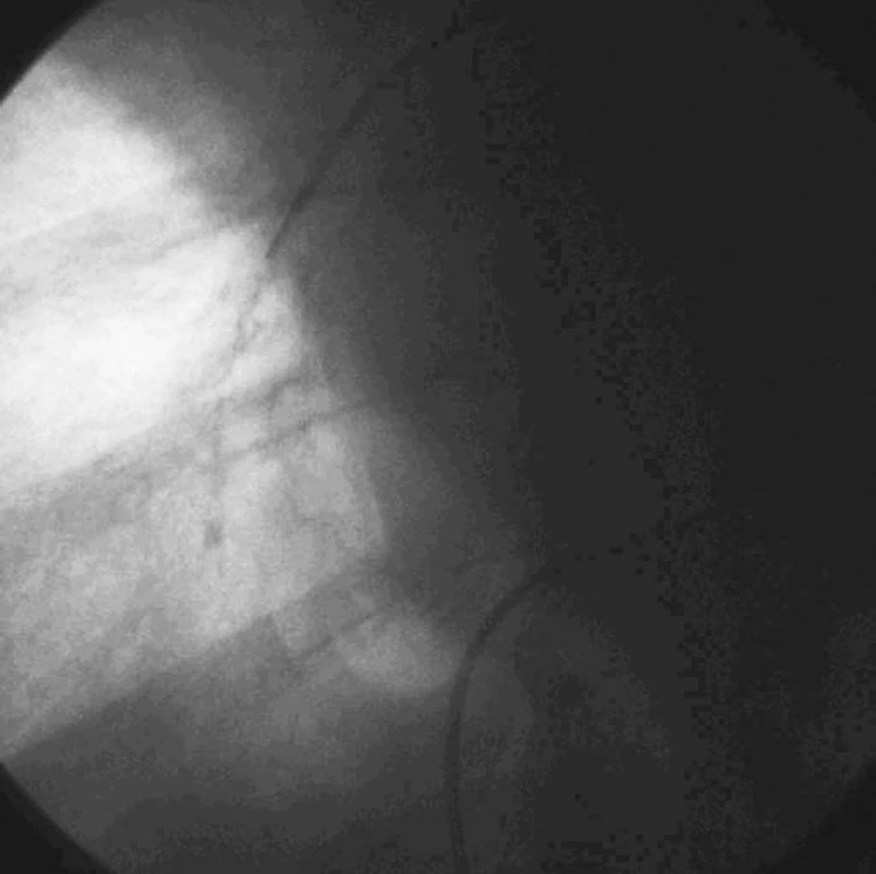Zavedení katétru do pravé plicní artérie
Fig. 1. Catheter introduction into the right pulmonary artery