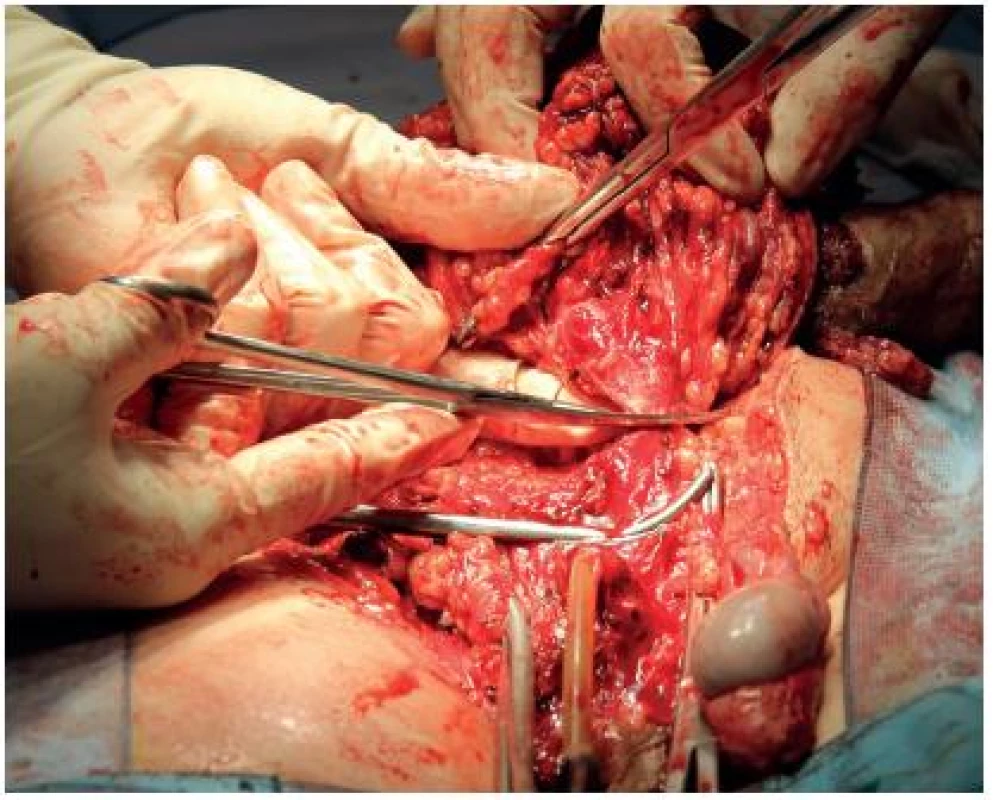 Peroperační snímek, excise ingvinoskrotální oblasti vpravo a penektomie
Fig. 6. Peroperative foto, excision of inguinoscrotal region with penectomy