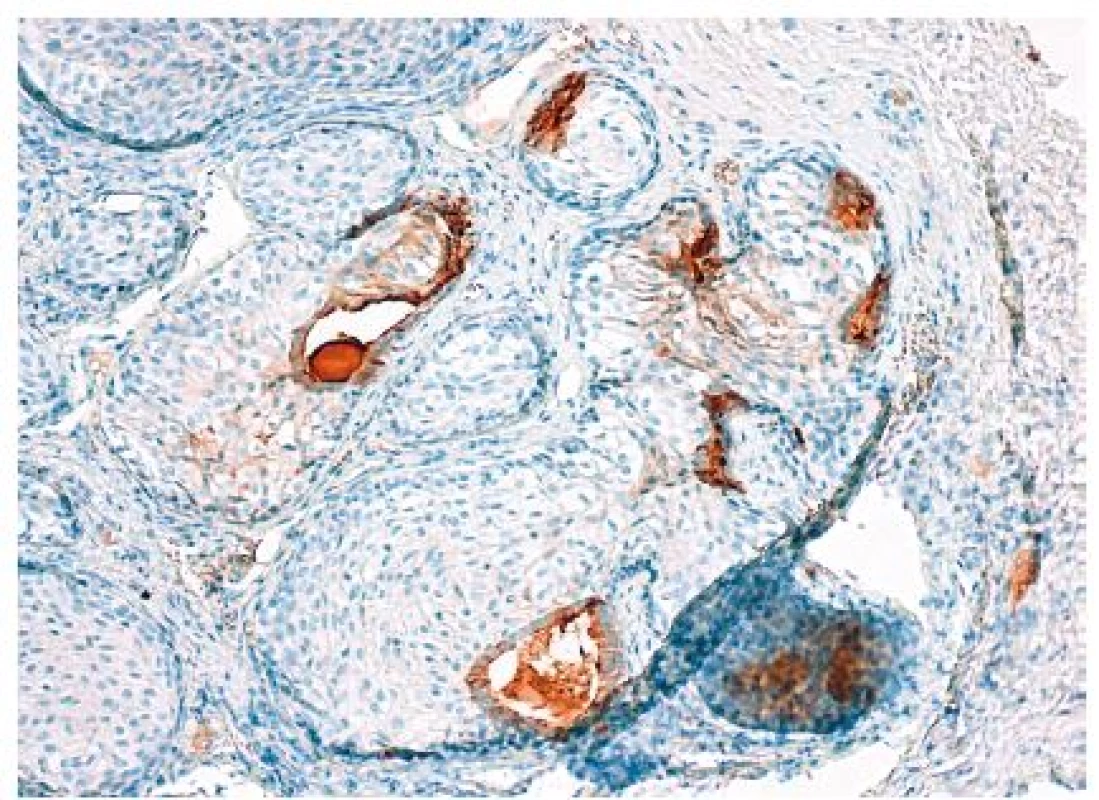 Imunohistochemická exprese prostatické specifické kyselé fosfatázy (PSAP) ve žlázové složce, zatímco dlaždicový epitel je negativní (původní zvětšení 100x)
