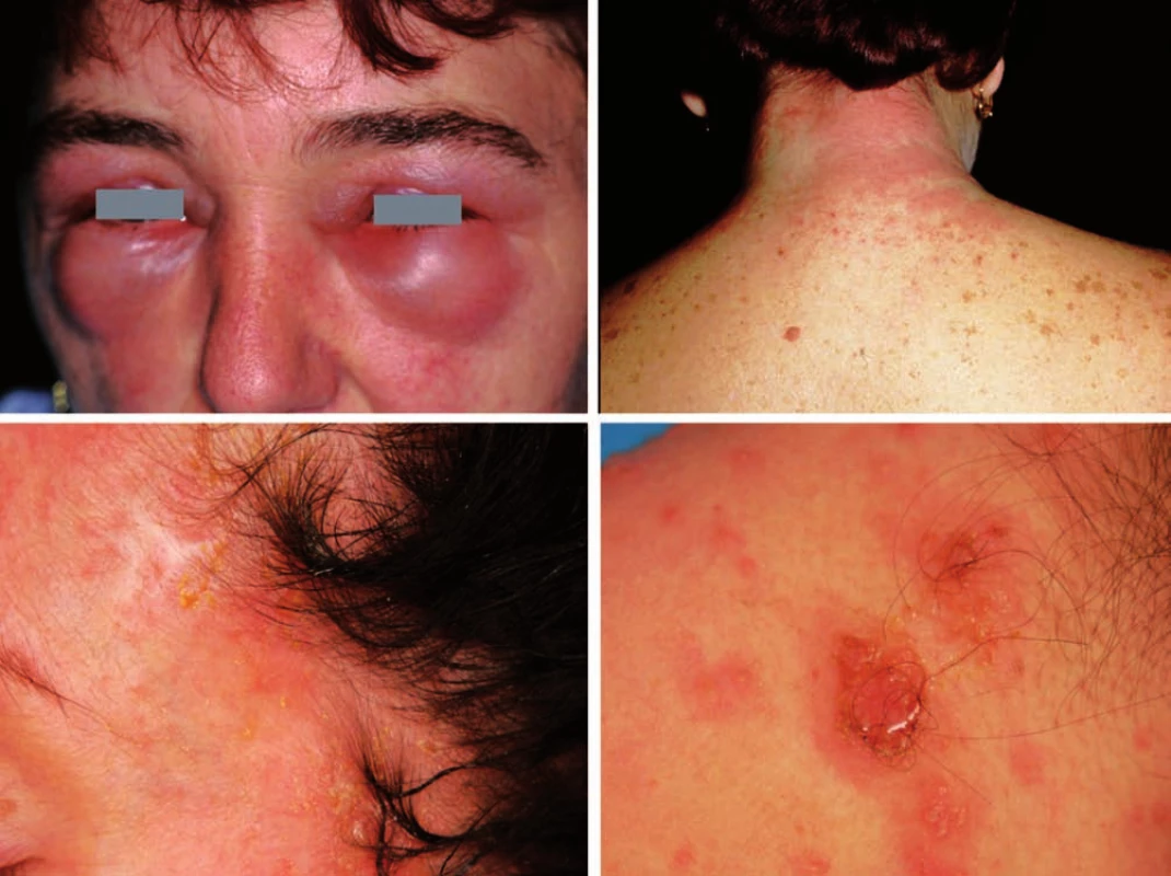 Eczema contactum – PPD (barva na vlasy)