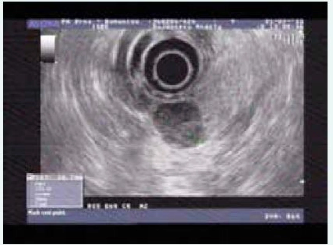 Endosonografie pNET (inzulinom)