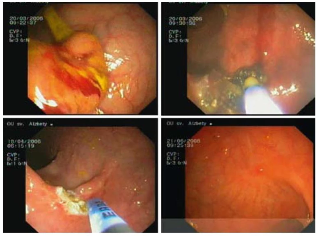APC liečba širokobázického adenómu rekta s ťažkou dyspláziou 2 sedenia, kontrola po 2 mesiacoch.
Fig. 3. APC therapy of broad-based rectal adenoma with high grade dysplasia 2 sessions, check-up after 2 months.