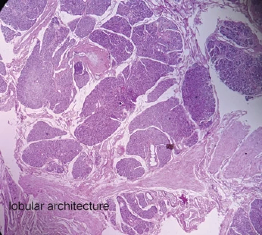 Low-power view of the heterotopic pancreatic tissue showing the lobular architecture of the pancreatic tissue.