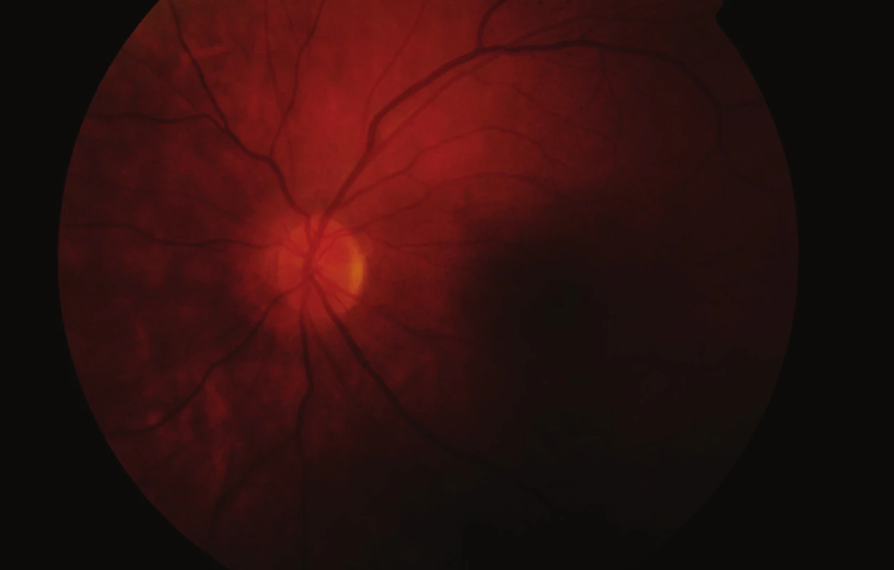 Fundus levého oka 2 měsíce po vzniku pretrombotického stavu