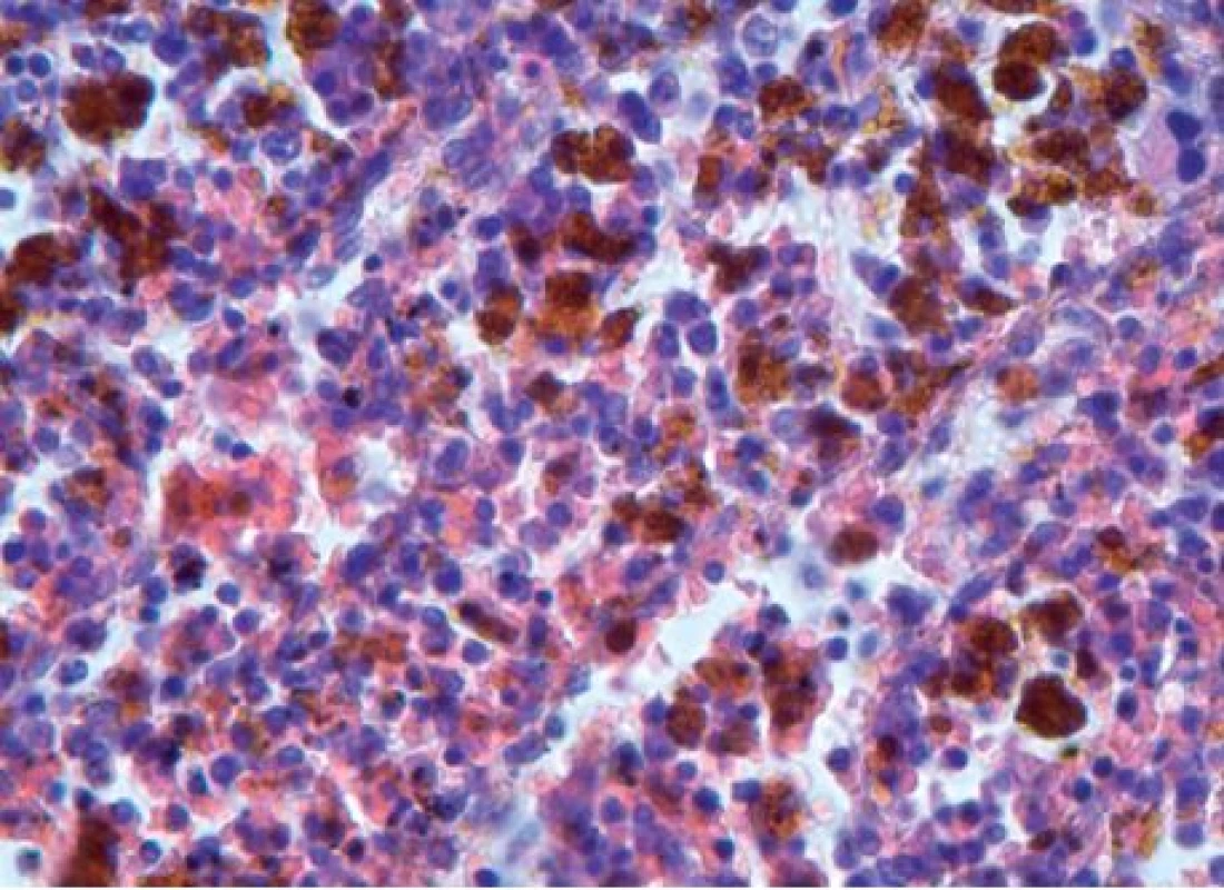 Mohutná depozita hemosiderinu ve slezině, hematoxylin-eosin