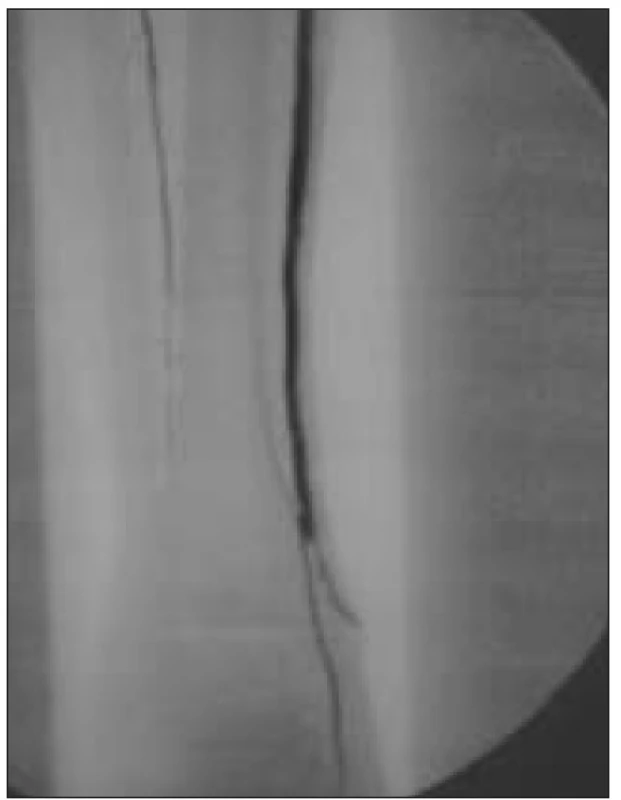 Angiografie – pedální bypass a volný svalový lalok – side to side anastomóza.