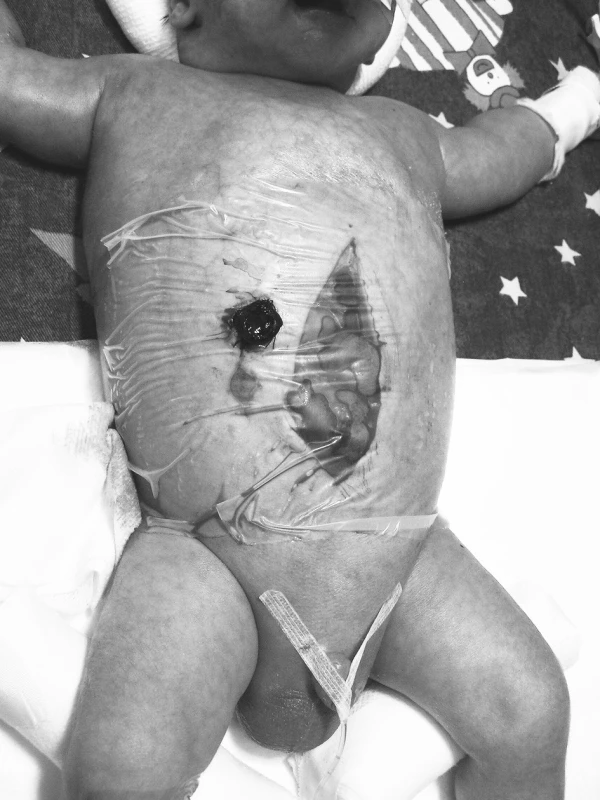 Břišní kompartment syndrom byl řešen přechodným překrytím laparotomie folií Steri-Drape
Fig. 2. The abdominal compartment syndrome was managed by temporary application of the Steri-Drape foil over the laparotomy site.