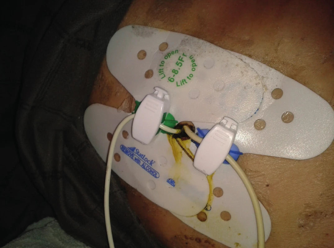 Obtekanie PTD katétra s výrazným leakom žlče navonok
Fig. 11: PTD catheter with external bile leak