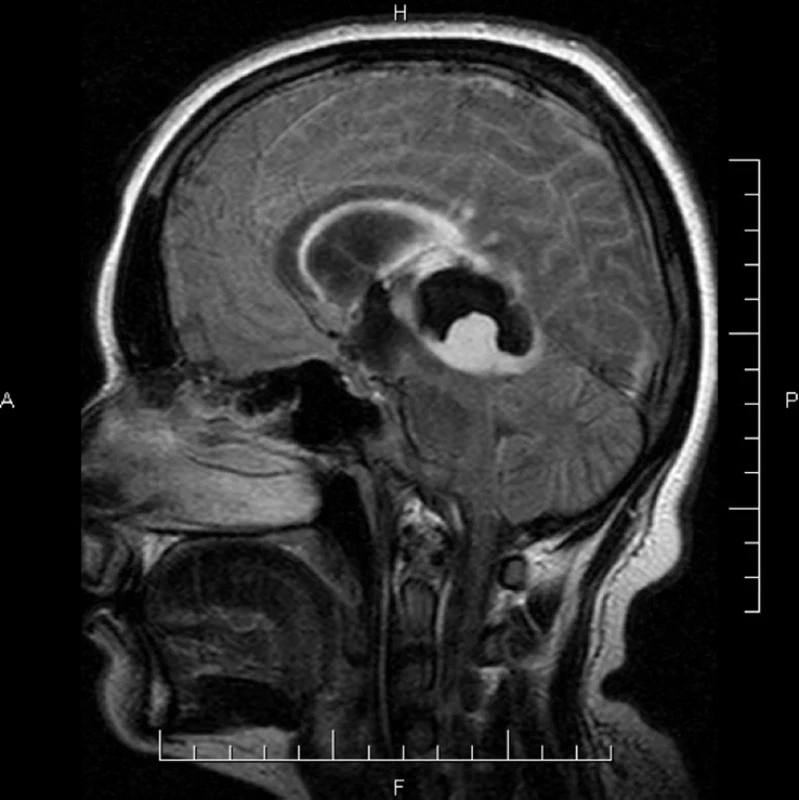 Obr. 3. MR T1 vážený obraz s použitím gadolinia prokazující recidivu onemocnění po 3 měsících. .</br> Fig. 3. MR T1W CE showing the recurrence of tumor.