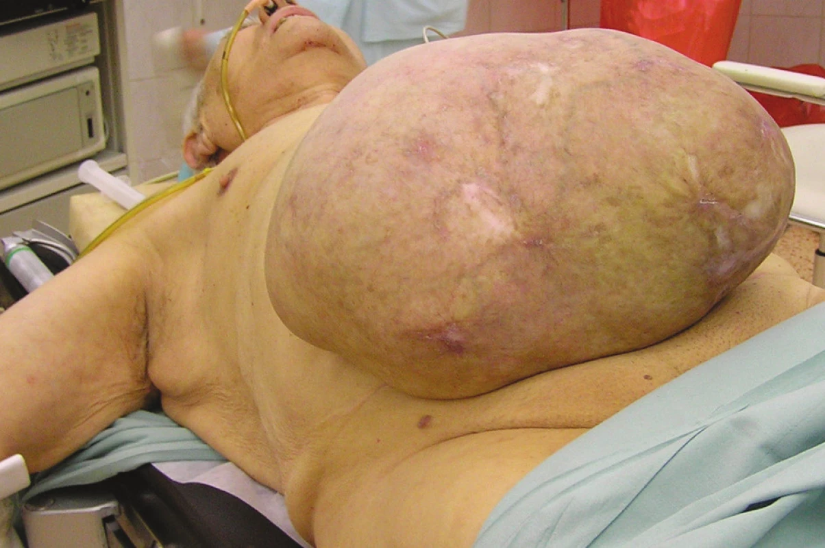 Inkarcerovaná ventrální kýla
Fig. 3. Incarcerated ventral hernia
