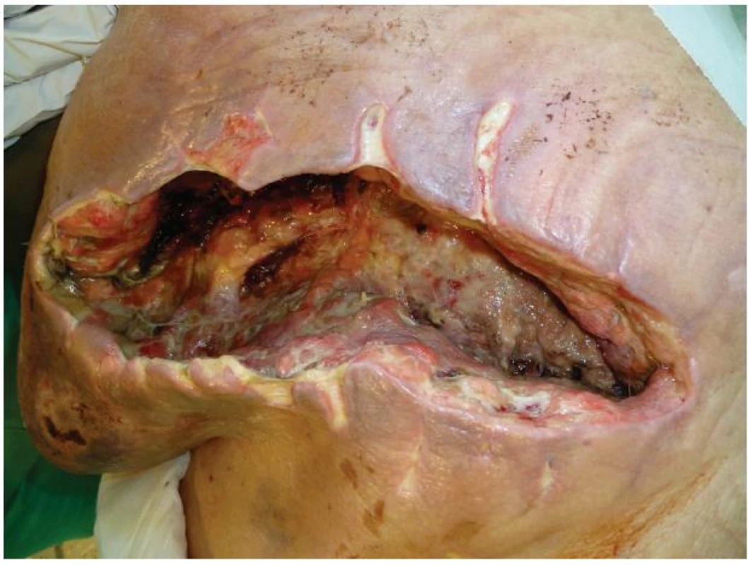 Stav rány před zahájením podtlakové terapie
Fig. 3: The condition of the wound before negative pressure wound therapy (NPWT)
