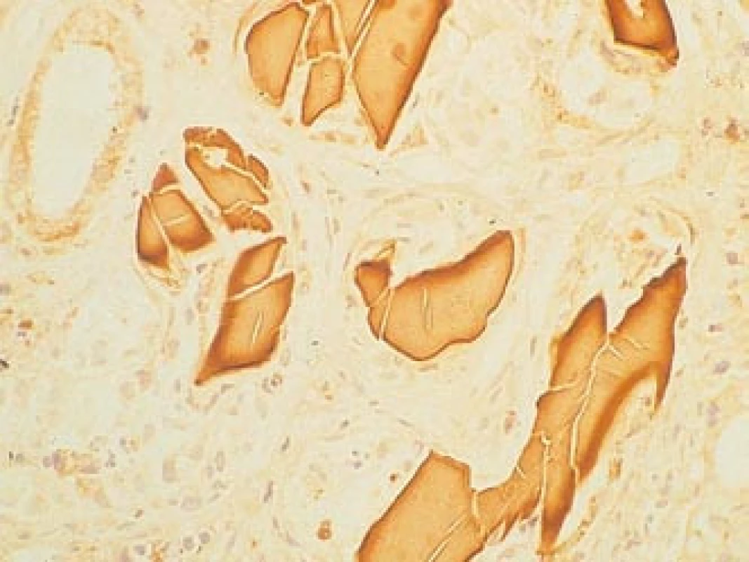 Průkaz pomocí biopsie ledviny s imunofluorescenčním nebo imunoperoxidázovým průkazem lehkých řetězců, které myelom produkuje.
