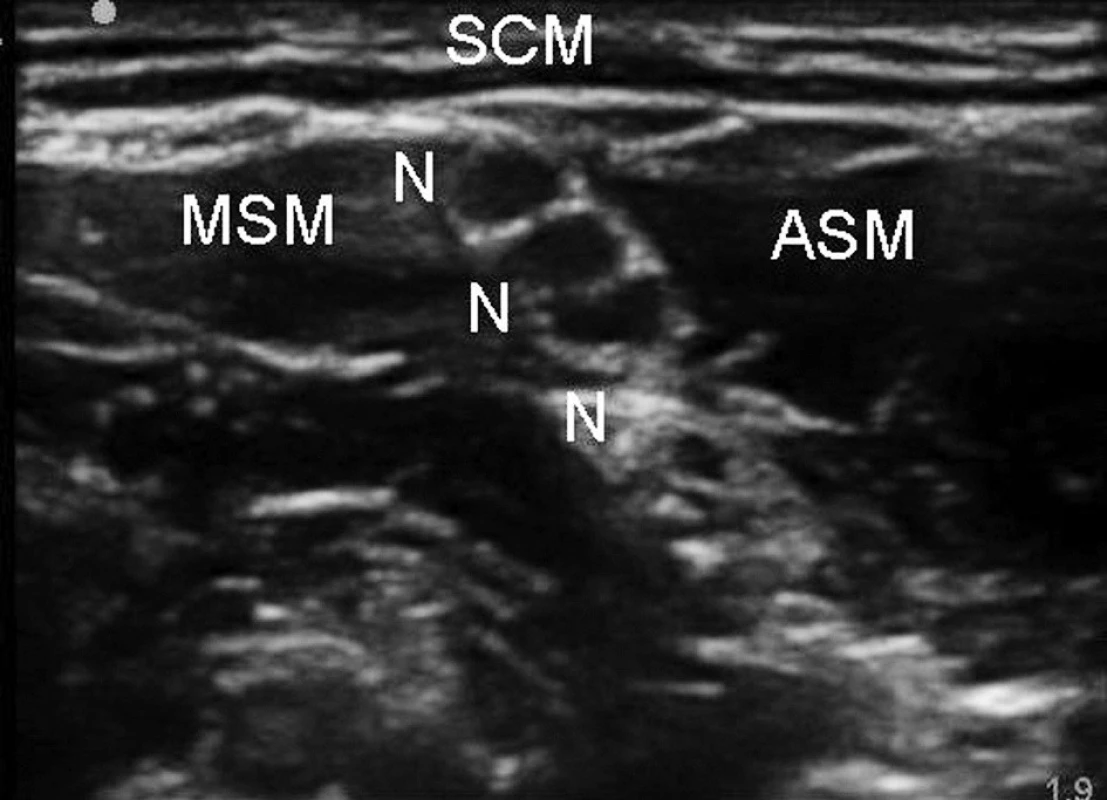 Interskalenická blokáda brachiálního plexu 
Legenda: N – nervové kořeny, ASM – musculus scalenus anterior, MSM – musculus scalenus medius, SCM – musculus sterno - cleidomastoideus