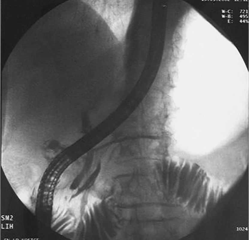 Endoskopická retrográdna cholangiopankreatikografia po troch mesiacoch od operácie pacientky s voľným prechodom kontrastnej látky do duodena 
Pic. 3. Endoscopic retrograd cholangiopancreatography with free passage of contast substance into duodenum three months after operation  
