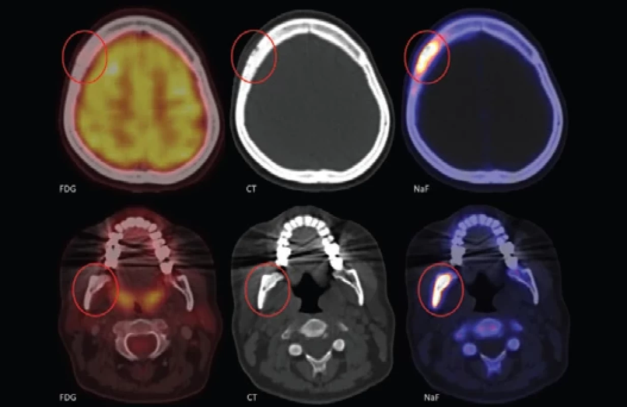 Kombinace FDG (v barevné škále Hot Body) a NaF (v barevné škále Hot Metal) PET/CT vyšetření v axiálních řezech lokalizovaných v místech maximálních patologií (v lebce frontoparietotemporálně vpravo – horní řada – a v mandibule vpravo – dolní řada). V místech osteosklerotických změn patrných na CT (sloupec uprostřed) je minimální (nezvýšená) akumulace FDG (sloupec vlevo), ale výrazně patologicky vysoká akumulace NaF (sloupec vpravo).
