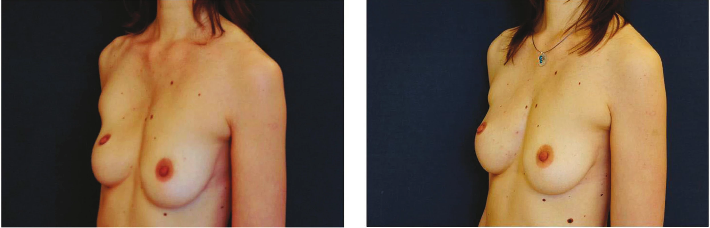 Pacientka s deformitou hrudního koše; před a 3 měsíce po korekci fatgraftingem
Fig. 4: Patient with chest deformity before and three months after reconstruction using fat graft