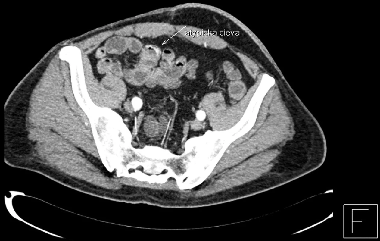 CT enterografia – snímok zachytávajúci cievnu malformáciu na terminálnom ileu (transverzálny rez)
Fig. 2. CT enterography – a view depicting a vascular malformation in the terminal ileum (transverse section)