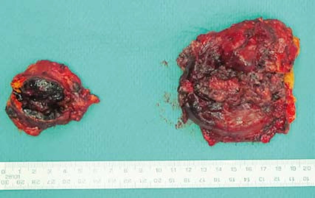 Preparát – tumorózně postižené nadledviny.
Fig. 4. Specimen – tumour affected adrenals.