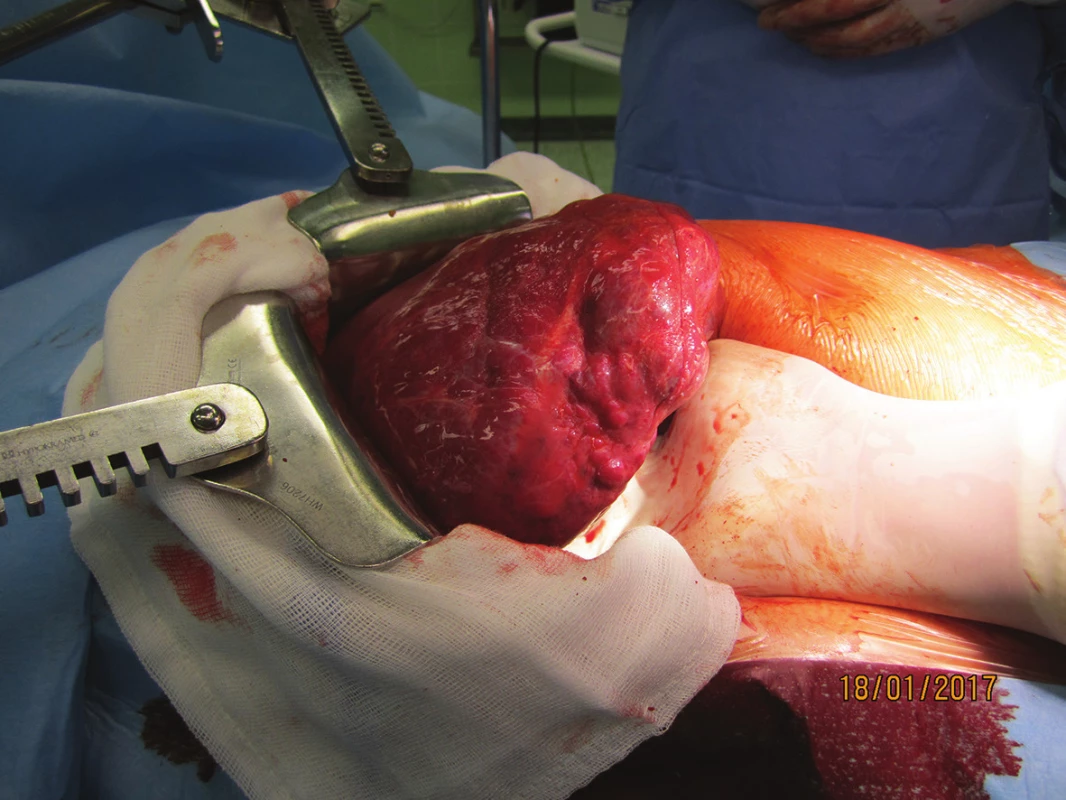 Gigantický kavernózní hemangiom jater – peroperační snímek
Fig. 3: Giant cavernous liver hemangioma – peroperative photo
