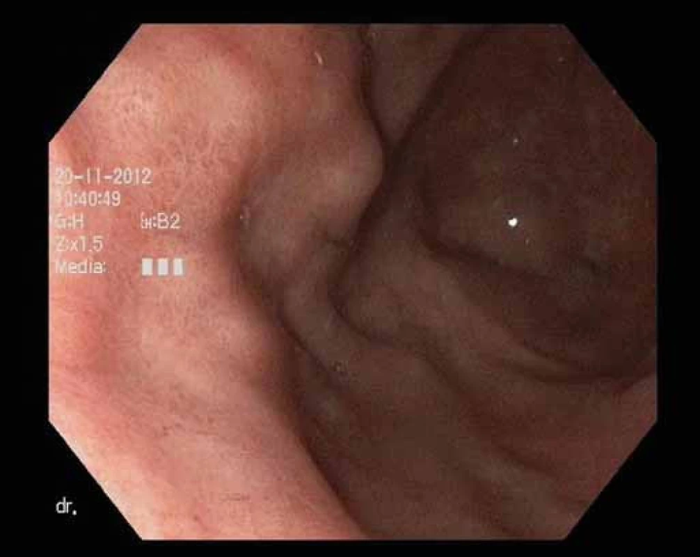Endoskopický obraz po terapii.
Fig. 6. Endoscopic image after therapy.