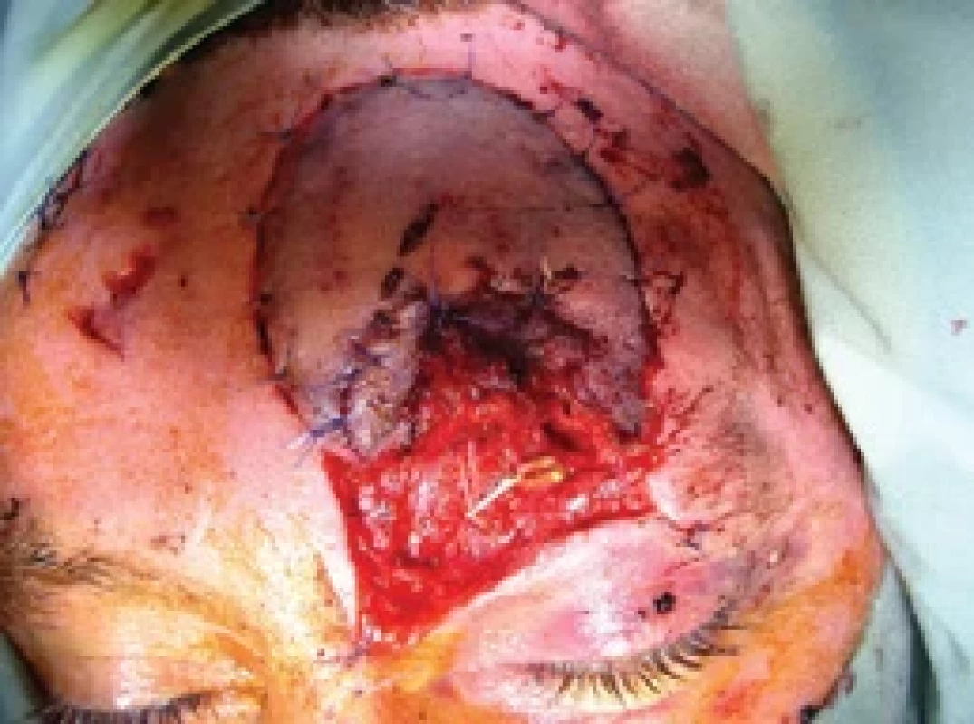 Microanastomosis of supratrochlear vessels. Source: archive of authors.