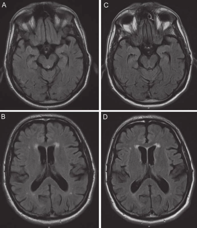 MR nález jen mírné atrofie temporálně a frontálně bez progrese v čase a diskrétní mikroangiopatie (odpovídající amyloidové angiopatii potvrzené neuropatologicky) na axiálních řezech v sekvencích FLAIR.
