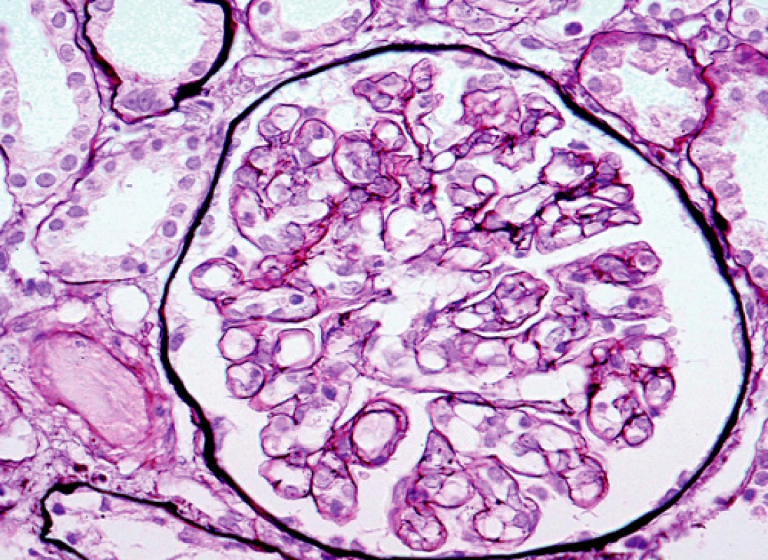 Glomerulus se zduřelými endoteliemi a tvorbou druhé vnitřní bazální membrány, která ložiskově vytváří dvojkontury
(barvení PASM [periodic acid – silver methenamine]; objektiv 40krát) 

