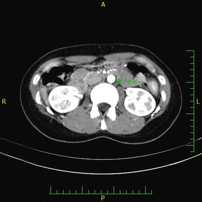 CT angiografie ukazující zjevné snížení vzdálenosti mezi aortou a horní mezenteriální arterií pod 7 mm u pacienta 2.
(Obrazový materiál Oddělení radiologie Nemocnice Karviná, MUDr. Kupková).
Fig. 6. CT angiography showing the reduction of aortomesenteric distance measuring about 7 mm (case report two).