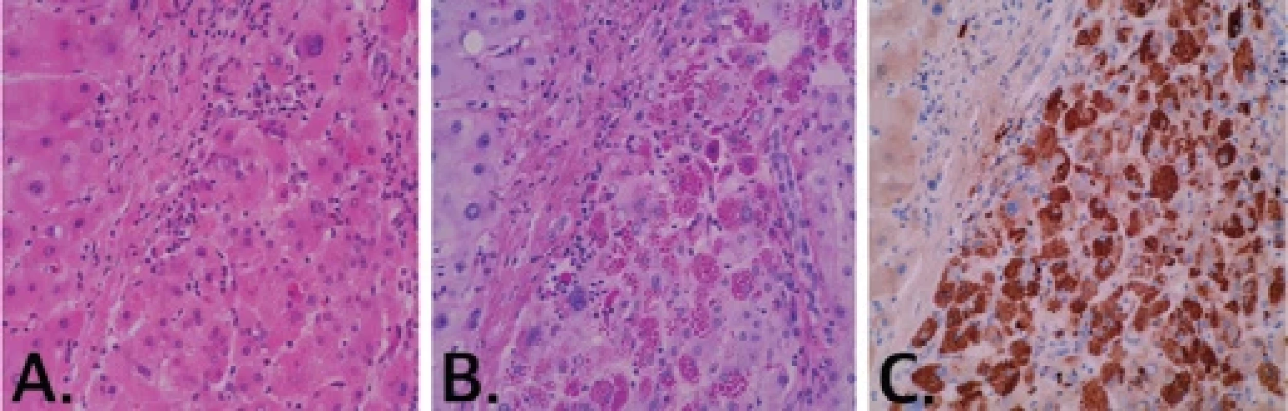AATD, histologické vyšetření explantátu jater.</br>Fig. 1. AATD, histological assessment of the liver explant.