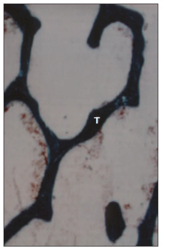 Histologický obraz normální kosti. Povrch trámčité kosti (T) je hladký, bez nápadnějších resorpčních lakun.