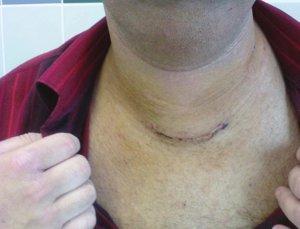 Pacient 5. pooperační den
Fig. 6: Patient on day 5 from surgery