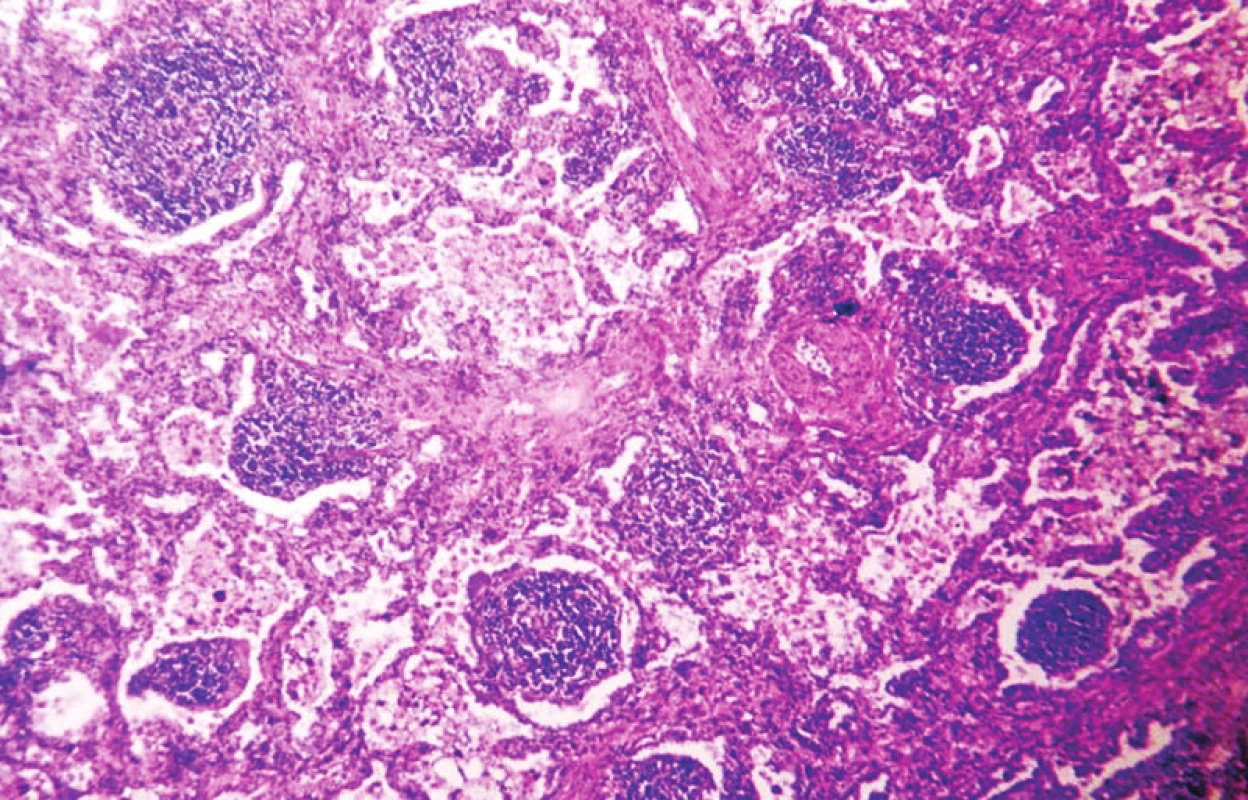 Lymfocytární intersticiální pneumonie s tvorbou lymfatických folikulů. HE, 120krát