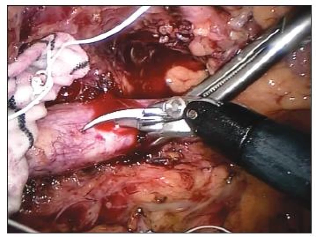 Robotické nůžky – aortotomie
Fig. 1. Robotic scissors – aortotomy
