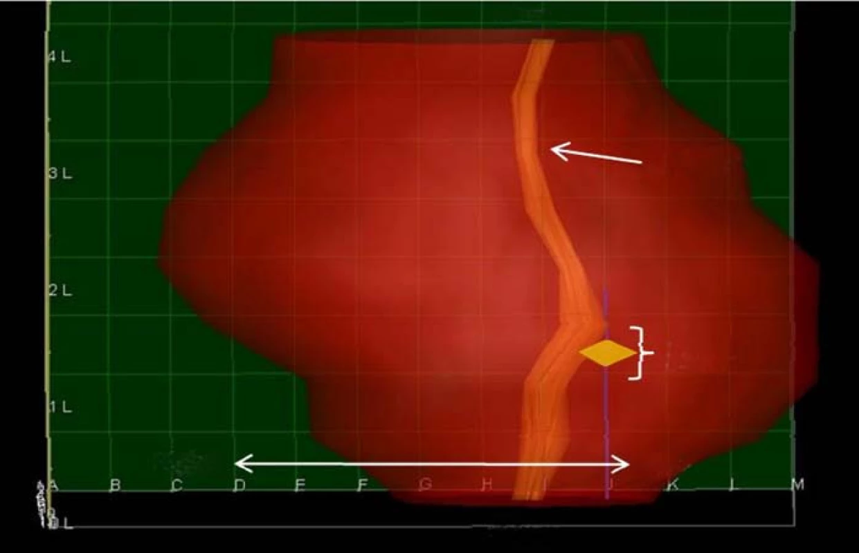 Zobrazení prostaty po 3DM biopsii. Karcinom je zobrazen jako žlutý kosočtverec.
Rovněž je zobrazen průběh močové trubice.