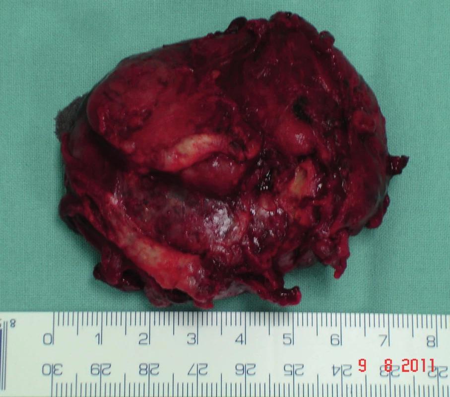 Odeslaný preparát na histologii
Fig. 8: The preparation for histology