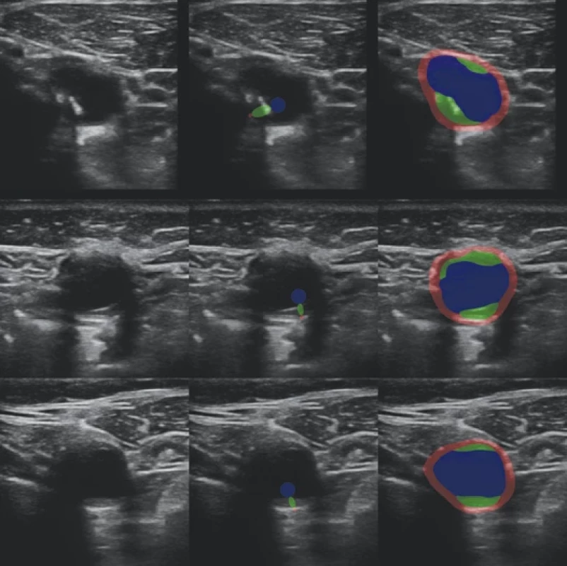 Example segmentations on the test part of the weakly labeled dataset. From the left: input image, automatically derived weak segmentation, automatic dense segmentation