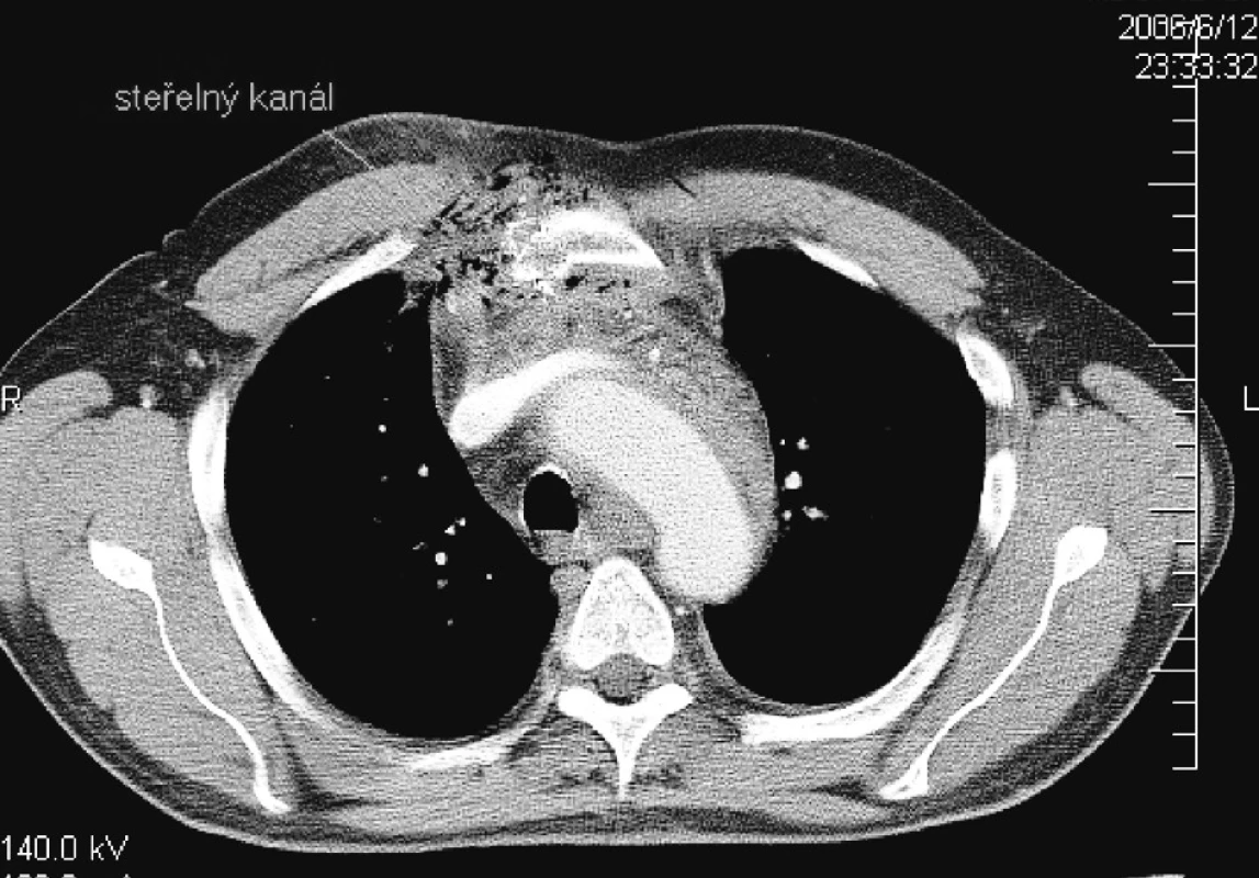 CT nález – Strelný kanál prechádzajúci pravým okrajom sterna
Pic. 1. CT finding – A shot canal traversing the right sternal edge