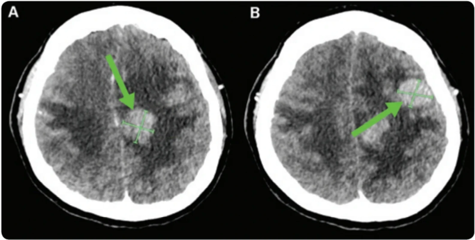 Baseline brain imaging. 